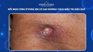 mụn cứng ở vùng kín