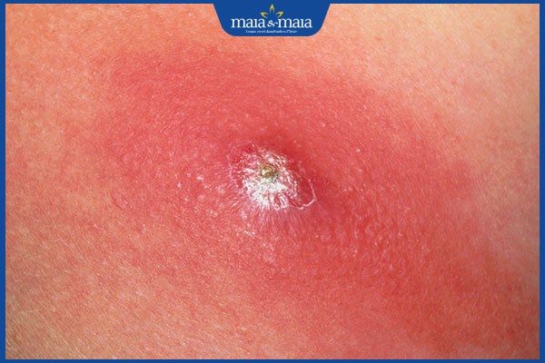 mụn cứng ở vùng kín sưng đỏ