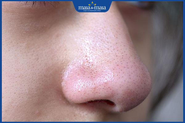 mụn đầu đen ở mũi