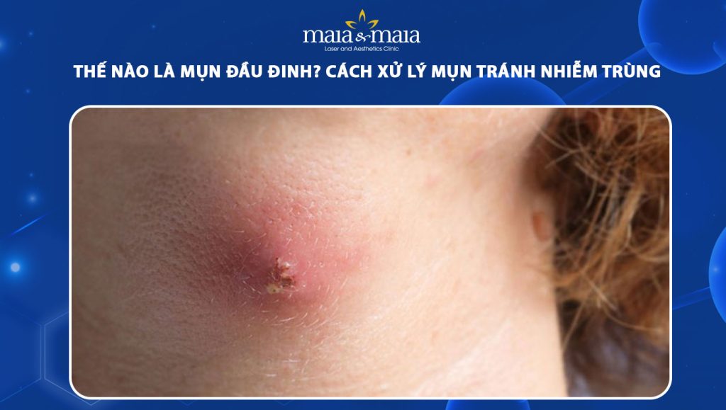 Mụn đầu đinh là như thế nào? Cách xử lý mụn tránh viêm nhiễm 1 mụn đầu đinh