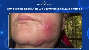 mụn đầu đinh kiêng ăn gì