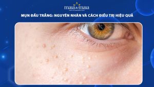 mụn đầu trắng