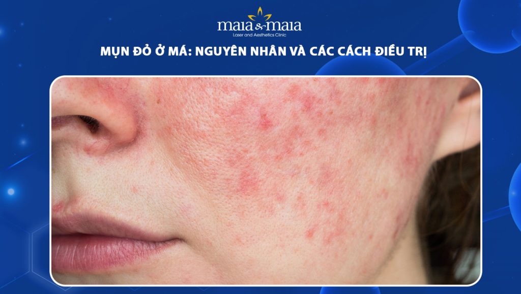 mụn đỏ ở má
