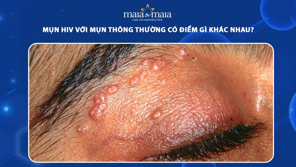 Mụn HIV với mụn thông thường có điểm gì khác nhau? 1 mụn hiv