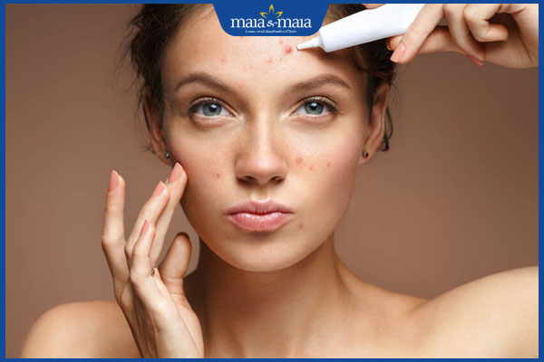 Có nên trị mụn bằng dung dịch vệ sinh? Rủi ro có thể gặp phải 3 mụn lây lan