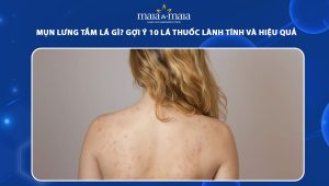mụn lưng tắm lá gì