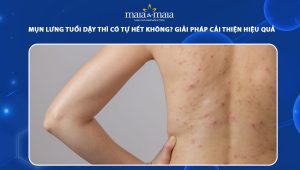 mụn lưng tuổi dậy thì