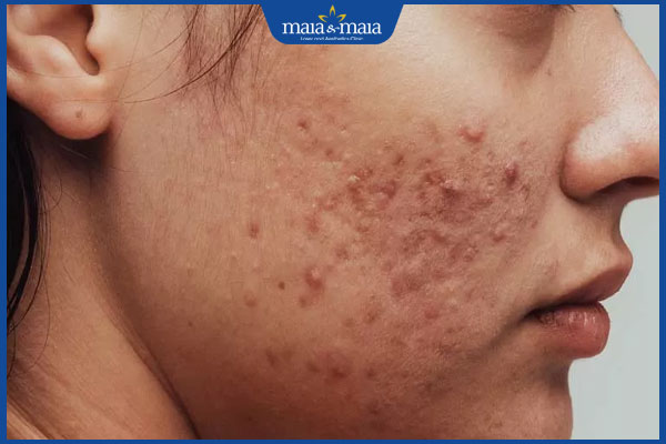 Mụn ở má có nên nặn không? Cách điều trị khoa học, hiệu quả 2 mụn mọc ở má