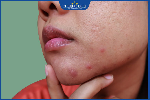 Mụn ở quai hàm hình thành do đâu? Điều trị như thế nào? 2 mụn mọc ở quai hàm