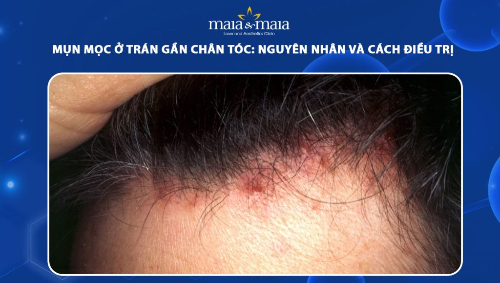 Mụn mọc ở trán gần chân tóc: Nguyên nhân và cách điều trị 1 mụn mọc ở trán gần chân tóc