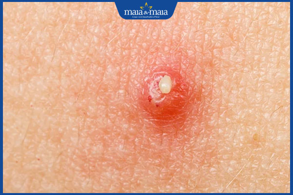 Thuốc kháng sinh trị mụn có tốt không? Lưu ý khi sử dụng 4 mụn mủ