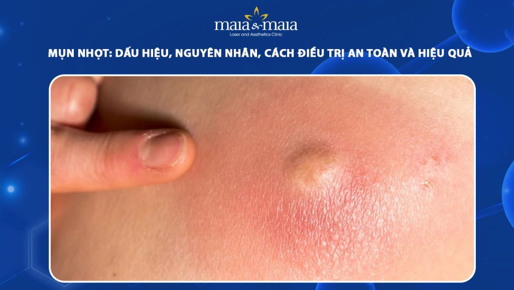 mụn nhọt