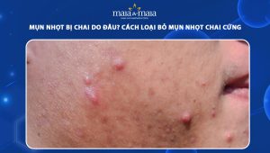mụn nhọt bị chai