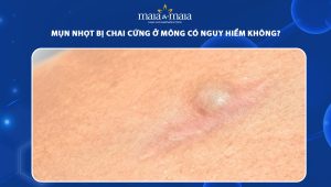 mụn nhọt bị chai cứng ở mông