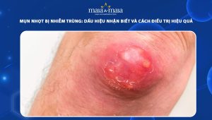 mụn nhọt bị nhiễm trùng