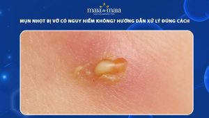 mụn nhọt bị vỡ