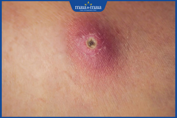 Mụn nhọt bị vỡ nguy hiểm không? Hướng dẫn xử lý đúng cách 2 mụn nhọt đã chín