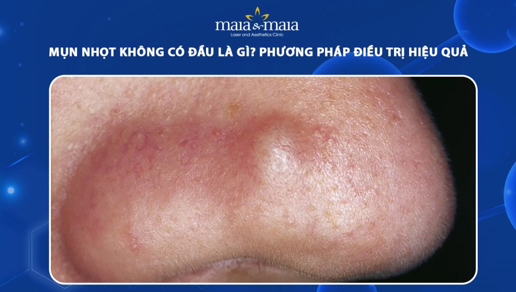 Mụn nhọt không có đầu là gì? Phương pháp điều trị hiệu quả 1 mụn nhọt không có đầu