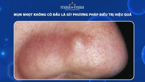 mụn nhọt không có đầu