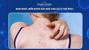 mụn nhọt mẩn ngứa