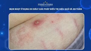 mụn nhọt ở bụng