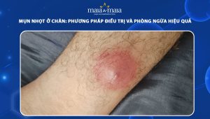 mụn nhọt ở chân