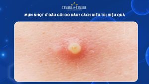 mụn nhọt ở đầu gối