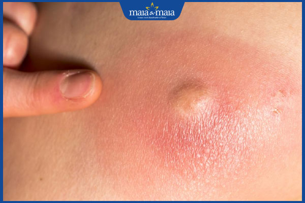 Mụn nhọt sau gáy có nguy hiểm không? Cách điều trị dứt điểm 3 mụn nhọt ở gáy sưng to