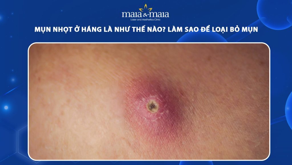 Mụn nhọt ở háng là như thế nào? Làm sao để loại bỏ mụn? 1 mụn nhọt ở háng