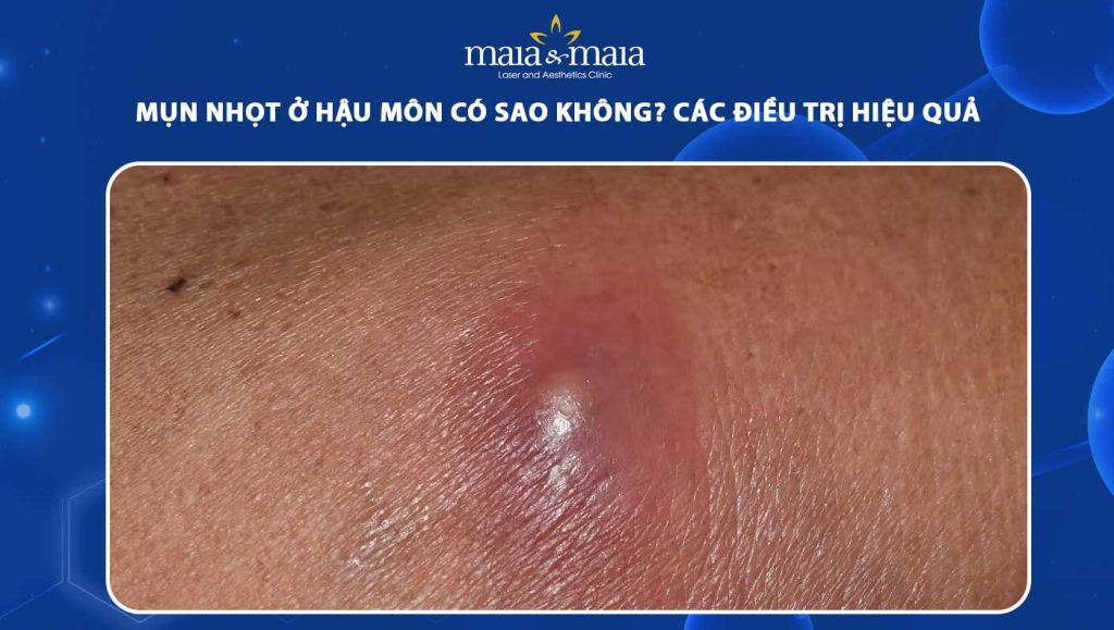 mụn nhọt ở hậu môn