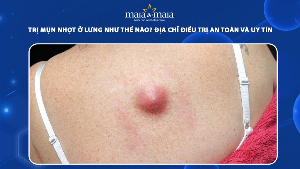 mụn nhọt ở lưng