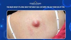 mụn nhọt ở lưng