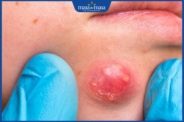 mụn nhọt ở mặt sưng to