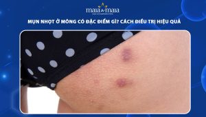 mụn nhọt ở mông