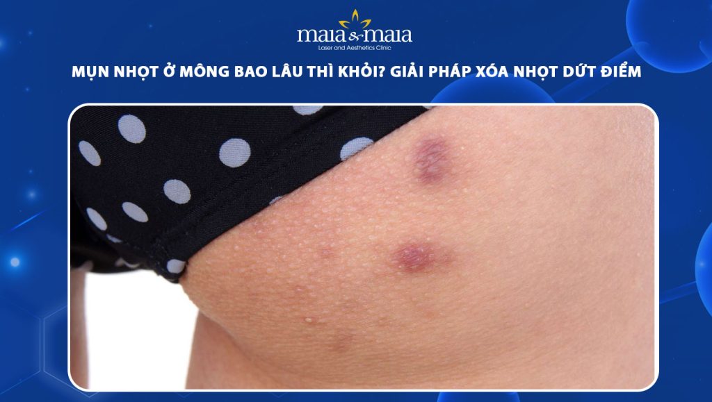 mụn nhọt ở mông bao lâu thì khỏi