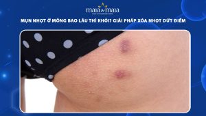 mụn nhọt ở mông bao lâu thì khỏi