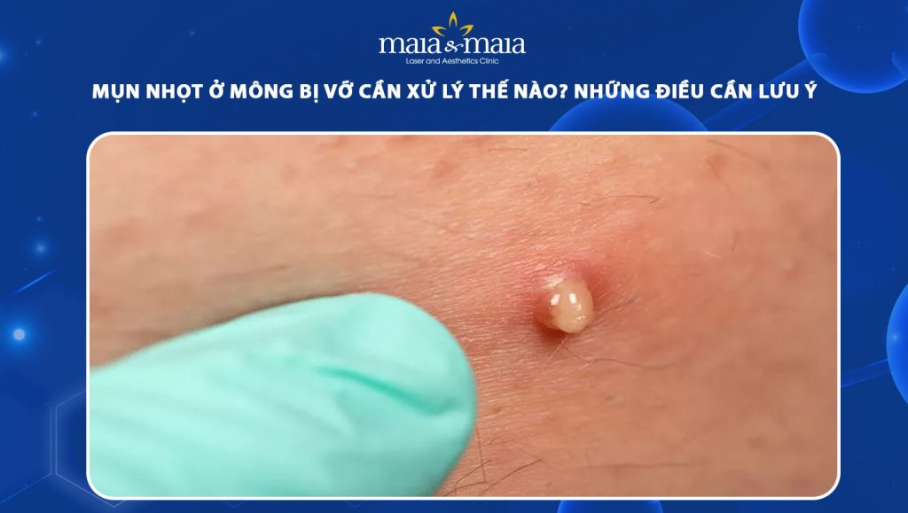 Cách xử lý mụn nhọt ở mông bị vỡ và lưu ý khi thực hiện 1 mụn nhọt ở mông bị vỡ