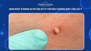 mụn nhọt ở mông bị vỡ