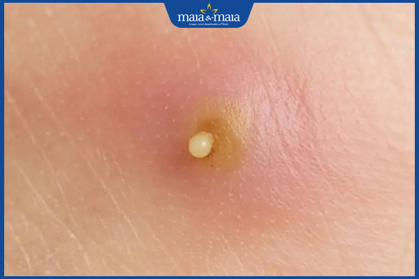 Bật mí các cách trị mụn nhọt ở mông hiệu quả, an toàn 2 mụn nhọt ở mông đã chín