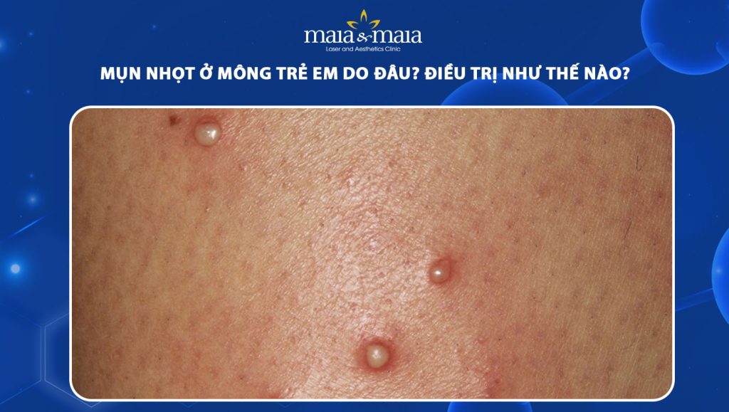 mụn nhọt ở mông trẻ em