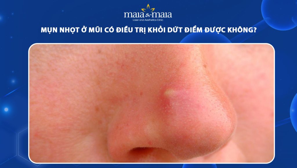 mụn nhọt ở mũi