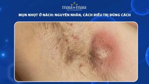 mụn nhọt ở nách