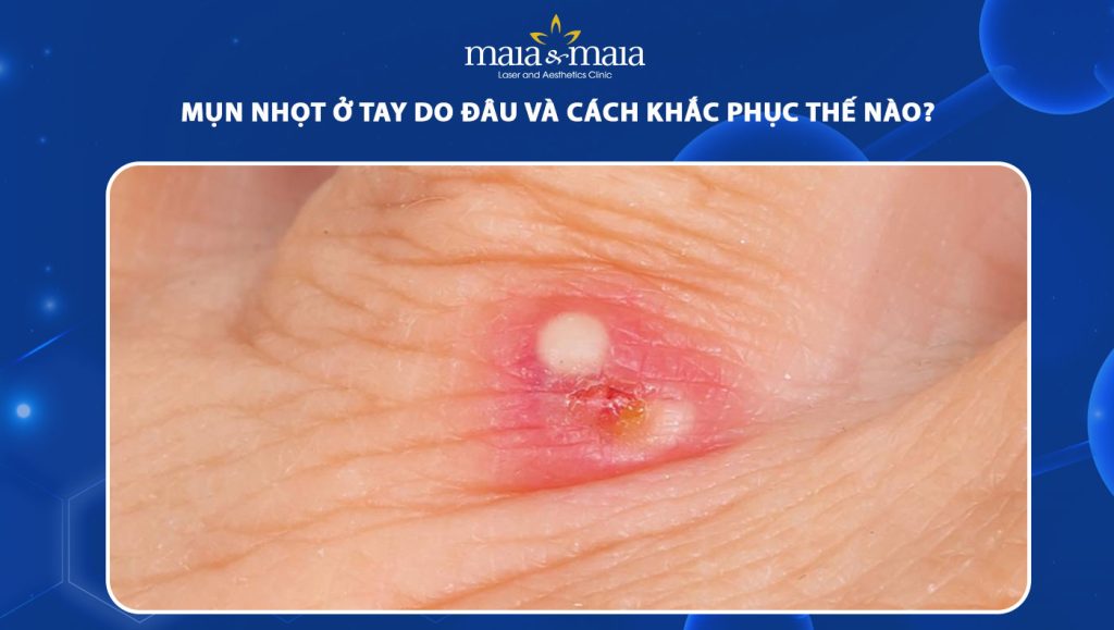 Mụn nhọt ở tay do đâu và cách khắc phục như thế nào? 1 mụn nhọt ở tay