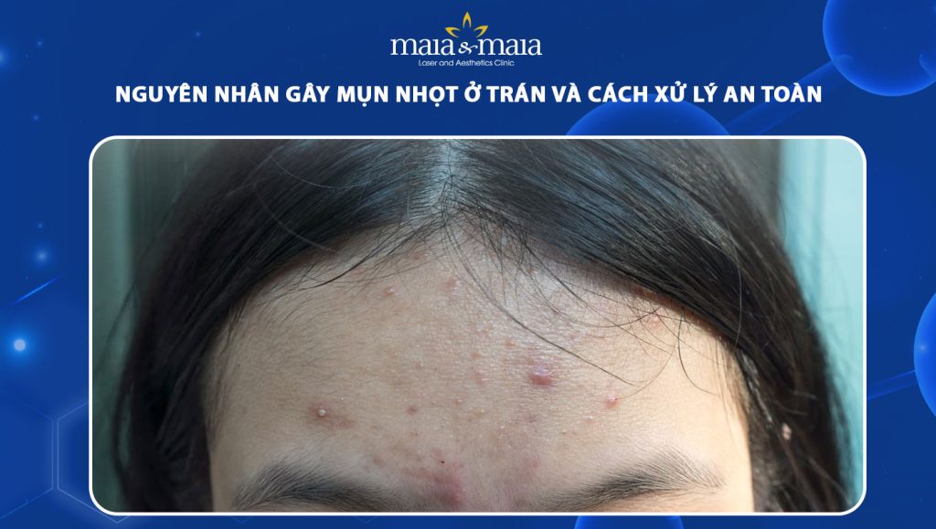 Nguyên nhân gây mụn nhọt ở trán và cách xử lý an toàn 1 mụn nhọt ở trán