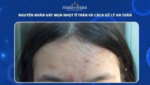 mụn nhọt ở trán