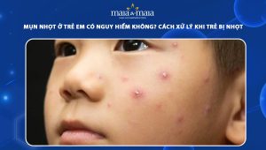 mụn nhọt ở trẻ em