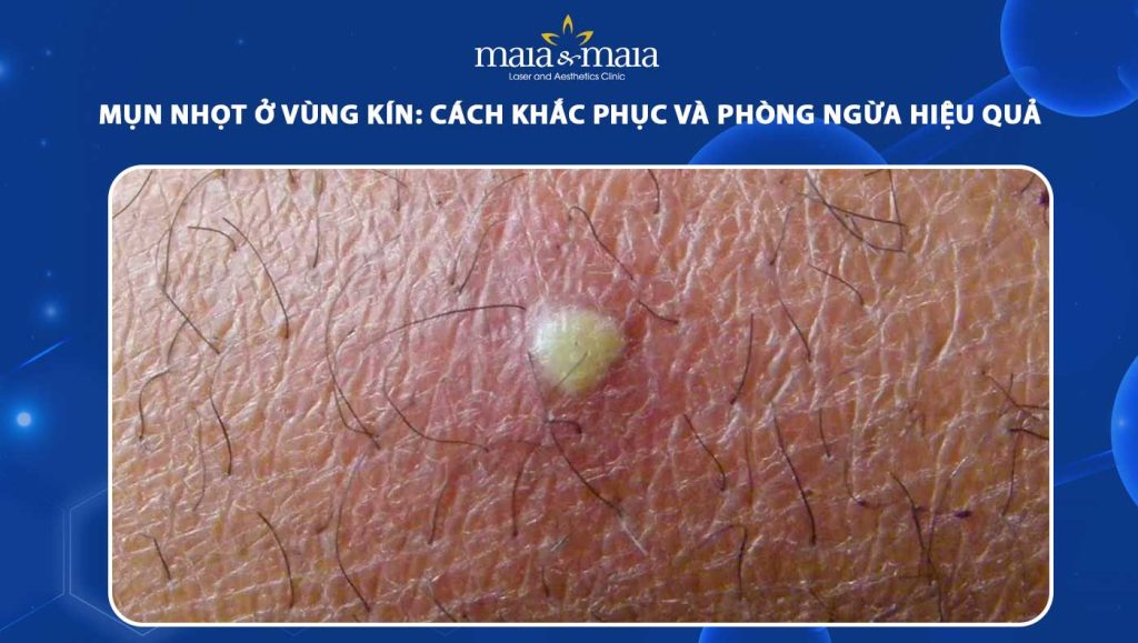 mụn nhọt ở vùng kín