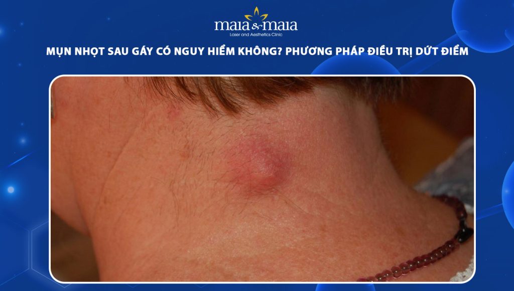 Mụn nhọt sau gáy có nguy hiểm không? Cách điều trị dứt điểm 1 mụn nhọt sau gáy