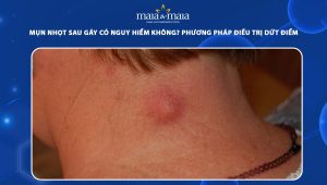 mụn nhọt sau gáy