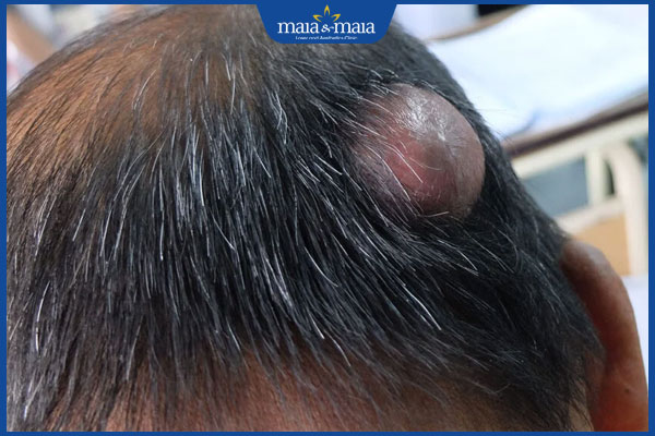 Mụn nhọt trên da đầu do đâu? Cách điều trị và phòng ngừa 3 mụn nhọt sưng to trên đầu